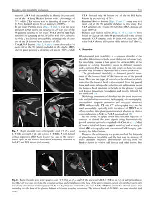 research. MRA had the capability to identify 10 cases only
out of the 14 bony Bankart lesions with a percentage of
71% while CTA success was in detecting all cases of the
14 bony Bankart lesions by an accuracy of 100%.
– In our study Perthes lesion (Figs. 15 and 19) was the most
prevalent labral injury and detected in 28 cases out of the
96 patients included in our study. MRA showed very high
sensitivity in detecting all the 28 lesions with 100% sensitiv-
ity while CTA showed less capability detecting only 16 cases
out of the 28 lesions by an accuracy of 57%.
– The ALPSA lesions (Figs. 2, 9 and 13) were detected in 16
cases out of the 96 patients included in this study. MRA
showed great potency in detecting all lesions (100%) while
CTA detected only 46 lesions out of the 60 Hill Sachs
lesions by an accuracy of 76%.
– Reversed Bankart lesions (Figs. 17 and 21) were seen in 6
cases out of the 96 patients included in this study. The
CTA detected only 4 cases (66%) while MRA detected all
cases (100%).
– Rotator cuff tendon injuries (Figs. 6, 10–12 and 16) were
found in 42 cases out of the 96 patients shared in the current
research. CTA detected only 14 cases with clear tear (33)
while MRA showed all injuries of the rotator cuff (100%).
4. Discussion
Glenohumeral joint instability is a common disorder of the
shoulder. Glenohumeral is the most labile joint in human body
for instability, because it has gained the extra-mobility at the
expense of stability. Instability occurs in different manners
and symptoms. Pain may be the only symptom; however, some
patients may have been expressed with a frank dislocation.
The glenohumeral instability is abnormal painful move-
ment of the humeral head of the humerus out of its glenoid
fossa. There are two types of instabilities the dislocation which
mean that the humeral head is disassociated from the glenoid
fossa and needs orthopaedic reduction and subluxation means
the humeral head translates to the edge of the glenoid, beyond
well known physiologic boundaries, and mostly followed by
self reduction (1).
Radiology assessment of shoulder has the most important
role and includes conventional radiography, ultrasonography,
conventional magnetic resonance and magnetic resonance
(MR) arthrography. CT and CT arthrography may also be
used successfully especially with the advent of MDCT as it
offers excellent three plane resolution when absolute or relative
contraindication to MRI or MRA is considered (2).
In our study, we apply direct intra-articular injection of
contrast to distend the joint capsule using ﬂuoroscopically
guided anterior approach as applied with Choi et al. (1). Most
of these articles had shown superior sensitivity and accuracy of
direct MR arthrography over conventional MR imaging, par-
ticularly for labral lesions.
However the arthroscopy is a golden method for diagnosis
of glenohumeral instability and the best way to showing of
many different structural abnormalities varying from the
Bankart lesion to rotator cuff damage and other lesions. But
Fig. 7 Right shoulder joint arthrography axial CT (A), axial
T1WI (B), coronal CT (C) and coronal T1WI (D). A well deﬁned
cortical depression (Hill Sachs lesion) was seen in the supero-
lateral aspect of the humeral head which was clearly identiﬁed in
both CT and MR images (red arrows).
Fig. 8 Right shoulder joint arthrography axial T1 WI fat sat (A), axial CT (B) and axial ABER T1WI fat sat (C). A well deﬁned linear
tear (GLAD) was seen involving the articular cartilage and extending into the base of the antero-inferior glenoid labrum (ﬂap tear) which
was clearly identiﬁed in both images (A and B). The ﬂap tear was conﬁrmed in the axial ABER TIWI (red arrow) that showed a linear tear
extending into the base of the glenoid labrum with intact scapular periosteum. The anterior band of the IGHL was seen stretched and
intact.
Shoulder joint instability evaluation 941
 