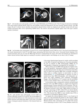 it has many disadvantages because its results varied according
to the skills of operator and being one of invasive procedure.
So now we depend on MR Arthrography (MRA)  CT
arthrography as diagnostic investigations for instability (3).
Many authors proved MR-Arthrography has highest sensi-
tivity and speciﬁcity, radiological method of assessment, and
the glenohumeral joint, but there may be limitations described,
most of which were general MRI such as metallic substances
within body as cochlear implant or pace-makers as well as
claustrophobia (4). CT-Arthrography in practice of work is
needed more than MR-Arthrography, and orthopaedic sur-
geons have high conﬁdence with computed tomography
images, wide distribution of CT scanners and the possibility
of CT to assess whether there is any bone loss at glenoid (5).
In the current study a comparative analysis was performed
between CTA and MRA ﬁndings as regards the frequencies
and percentage of lesions detected in the 96 patients. The car-
tilaginous Bankart lesion was detected in 16 patients out of the
96 patients involved in this study. MRA detects all these 16
cases by a percentage of 100% while CTA can clearly identify
12 cases only out of the 16 patients by a lower sensitivity of
75%. This showed that MRA is more reliable than CTA in
assessment of cartilaginous Bankart lesion.
As regards the osseous Bankart lesion, it was found in 14
cases out of the presented 96 patients in this research. MRA
had the capability to identify 10 cases only out of the 14 bony
Bankart lesions with a percentage of 71% while CTA success
was in detecting all cases of the 14 bony Bankart lesions by
Fig. 9 Left shoulder joint arthrography axial CT (A), axial T1WI (B)  axial T1WI fat sat (C). The CT image (A) showed an ill deﬁned
faint antero-inferior glenoid labrum which was seen medially rotated and delineated by the intra articular injected contrast. The MR
images (B and C) showed clearly identiﬁed antero-inferior glenoid labrum which was displaced and medially rotated with still intact
scapular periosteum (blue arrow) representing ALPSA lesion. The anterior and posterior capsules appear intact with type I anterior
capsular attachment.
Fig. 10 Left shoulder joint arthrography Coronal CT (A), coronal T1WI (B)  coronal T1WI fat sat (C). Tiny focal cortical depression
was clearly demonstrated in both CT and MR images representing Hill Sachs lesion (blue arrow). Associated lateral slopping of the
acromio-clavicular joint axis was seen the MR images (B and C) compromising the rotator cuff outlet with thinned out supraspinatus
tendon showed intrinsic bright signal not reaching its acromial or glenoid aspects; such ﬁndings are not clear in the CT images.
Fig. 11 Left shoulder joint arthrography coronal T1WI (A),
coronal T2WI (B), coronal CT (C and D). The coronal MR  CT
images showed full thickness tear of the supraspinatus tendon with
muscle retraction and tendon gap which is more clear in the MR
images. Consequent upward translation of the humeral head was
noted.
942 A. Elkharbotly
 
