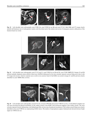 Fig. 12 Left shoulder joint arthrography axial T1WI (A), axial T1WI fat sat (B) and axial CT (C). Both MR and CT images clearly
identify full thickness tear of subscapularis tendon with free distal end of the tendon (red arrow). Consequent anterior subluxation of the
humeral head was noted.
Fig. 13 Left shoulder joint arthrography axial CT (A and C), axial T1WI fat sat (B and D), axial T1WI ABER (E). Images (A and B)
showed medially displaced antero-inferior labral tear (ALPSA) delineated by the intra articular injected contrast being more clear in the
CT image (red arrows). Anterior capsular tear as well as torn anterior band of the IGHL was noted in images (C and D) and more clearly
identiﬁed in axial ABER (blue arrows).
Fig. 14 Left shoulder joint arthrography coronal CT (A), coronal T1WI (B) and coronal T1WI fat sat (C). A well deﬁned complete tear
was seen involving the glenoid attachment of the axillary pouch of the IGHL with downward sagging of the axillary pouch. The intra
articular injected contrast delineating a well deﬁned gap (blue arrows) near the glenoid attachment of the axillary pouch being more clearly
identiﬁed in the axial T1WI fat sat representing GAGL lesion. The tendon of supraspinatus appear thickened and showed intrinsic bright
signal on T1WI  fat sat.
Shoulder joint instability evaluation 943
 