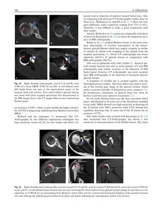 an accuracy of 100%. Such a result clariﬁes the higher sensitiv-
ity of CTA in diagnosing underlying bony Bankart lesion than
MRA.
Richard and his colleagues (6) mentioned that CT-
Arthrography by two different experienced radiologists has
high sensitivity results (91.6% for ﬁrst reader and 88.8% for
second one) in detection of anterior located labral tears. Also
in comparing with previous CT-Arthrography studies done by
Zwar et al., Mulligan et al. and Soh et al. (7–9) there was very
great difference, with a sensitivity ranging from 72% to 93%.
Therefore, it was difﬁcult to make a good comparison with
their results.
Instead, Richard et al. (6) results are comparable with those
of previous Kassarjian et al. (10) to assess the diagnostic accu-
racy of MR arthrography.
Khedr et al. (11) studied Bankart lesion as the most com-
mon abnormality. It involves interruption of the antero-
inferior glenoid labrum which may appear irregular in outline
or entirely be absent with stripping of the capsule from the
scapular periosteum (4). Direct CT arthrography has lower
sensitivity (84.2%) of glenoid lesions in comparison with
MR arthrography (94.7%).
This was in agreement with other studies (2). Anterior gle-
noid margin fracture was seen in seven patients. CT and MR
arthrography had similar accuracy in the detection of Hill
Sachs lesion; however, CT arthrography was more accurate
than MR arthrography in the detection of fractured anterior
glenoid margin.
A fragment of variable size is avulsed together with the
labroligamentous complex. This bony defect may lead to rever-
sal of the normal pear shape of the glenoid surface, which
makes recurrent episodes of dislocations more common (12).
So preoperative assessment of glenoid bone loss must be
known to prevent post operative recurrence (13).
In our study Perthes lesion was the most prevalent labral
injury and detected in 28 cases out of the 96 patients included
in our study. MRA showed very high sensitivity in detecting all
the 28 lesions with 100% sensitivity while CTA showed less
capability detecting only 16 cases out of the 28 lesions by an
accuracy of 57%.
Our study results come in hand with Kassarjian et al. (10)
who mentioned that CT-Arthrography has shown a low
sensitivity in characterization of the Perthes lesion. The intact
Fig. 15 Right shoulder arthrography axial CT (A and B), axial
T1WI (C), Axial ABER T1WI fat sat (D). A well deﬁned small
Hill Sachs lesion was seen at the supero-lateral aspect of the
humeral head (red arrows). Torn antero-inferior glenoid labrum
was noted with intact scapular periosteum best demonstrated in
the MR images than in the CT images (blue arrows) representing
Perthes lesion.
Fig. 16 Right shoulder joint arthrography axial  coronal CT (A and D), axial  coronal T1WI (B and E), axial and coronal T1WI fat
sat (C and F). A well deﬁned ﬁssure fracture line was seen involving the antero-inferior bony glenoid margin (image A) and seen as a low
signal line on T1WI  fat sat representing bony Bankart’s lesion (blue arrows). Lateral and downward slopping of the acromion process
was seen effacing the underlying peritendinous fat plane and gently indenting the supraspinatus tendon (red arrows).
944 A. Elkharbotly
 