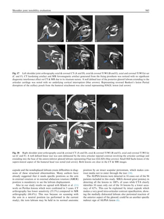capsule and the nondisplaced labrum create difﬁculties in diag-
nosis of these structural abnormalities. Many authors have
already suggested that it needs speciﬁc positions as the arm
in external rotation or in external abduction rotation (ABER)
position is mandatory to see the labrum displacement.
Also in our study results we agreed with Khedr et al. (11)
work on Perthes lesions which were conﬁrmed in 3 cases. CT
arthrography has lower sensitivity (33.3%) compared to MR
arthrography (66.6%). This was because on scanning with
the arm in a neutral position (as performed in the current
study), the torn labrum may be held in its normal anatomic
position by an intact scapular periosteum, which makes con-
trast media not to enter through the tear (14).
The ALPSA lesions were detected in 16 cases out of the 96
patients included in this study. MRA showed great potency in
detecting all the lesions in 100% of cases while CTA clearly
identiﬁes 10 cases only out of the 16 lesions by a lower accu-
racy of 62%. This can be explained by intact capsule which
makes a very good intra-articular contrast opaciﬁcation, show-
ing the medially dislocated labrum also periosteal reaction of
the anterior aspect of the glenoid, could be an another speciﬁc
indirect sign of ALPSA lesion (6).
Fig. 17 Left shoulder joint arthrography axial  coronal CT (A and D), axial  coronal T1WI (B and E), axial and coronal T1WI fat sat
(C and F). CT hardening artefact and MR ferromagnetic artefact generated from the ﬁxing prosthesis was noticed with no signiﬁcant
diagnostic interference effect on CT  MR due to its titanium nature. A well deﬁned tear of the posterior glenoid labrum extending to the
articular cartilage was noted with no underlying cortical interruption (blue arrows). Representing reversed Bankart’s lesion Partial
disruption of the axillary pouch from the humeral attachment was also noted representing HAGL lesion (red arrow).
Fig. 18 Right shoulder joint arthrography axial  coronal CT (A and D), axial  coronal T1WI (B and E), axial and coronal T1WI fat
sat (C and F). A well deﬁned linear tear was seen delineated by the intra articular injected contrast involving the articular cartilage and
extending into the base of the antero-inferior glenoid labrum representing Flap tear (GLAD) (blue arrows). Small Hill Sachs lesion of the
supero-lateral aspect of the humeral head was noted (red arrow). Both lesions are clear in the CT  MR images.
Shoulder joint instability evaluation 945
 