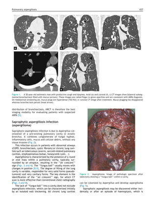Pulmonary aspergillosis 437
Figure 1. A 30-year-old asthmatic man with productive cough and dyspnea. Axial (a) and coronal (b, c) CT images show bilateral subseg-
mental bronchectasis ﬁlled with mucus (arrows). These images are called ﬁnger-in-glove opacities and are consistent with ABPA diagnosis.
On mediastinal windowing (d), mucus plugs are hyperdense (102 HU); e: coronal CT image after treatment. Mucus plugging has disappeared
whereas bronchectasis persist (head arrow).
distribution of bronchiectasis, HRCT is therefore the best
imaging modality for evaluating patients with suspected
ABPA [5].
Saprophytic aspergillosis infection
(aspergilloma)
Saprophytic aspergillosis infection is due to Aspergillus col-
onization of a pre-existing pulmonary cavity or ectatic
bronchus. It combines conglomerate of fungal hyphae,
inﬂammatory cells, mucus and cellular debris, without any
tissue invasion (Fig. 2).
This infection occurs in patients with abnormal airways
(COPD, bronchiectasis, cystic ﬁbrosis) or chronic lung cavi-
ties such as tuberculous caverns, sarcoid-related pulmonary
cavities, emphysematous bullae, honeycomb cysts. . .).
Aspergilloma is characterized by the presence of a round
or oval mass within a pulmonary cavity, typically sur-
rounded by an airspace, resulting in the ‘‘air crescent’’
sign (Figs. 3 and 4). The ‘‘fungus ball’’ usually moves with
changes in position [8,9]. The degree of ﬁlling of the lung
cavity is variable, responsible for very solid forms (pseudo-
tumoral) and very cavitary forms. The key element is the
identiﬁcation of the ‘‘air crescent’’ sign, for which CT
scan is more effective than conventional chest radiography
(Figs. 3 and 4).
The lack of ‘‘fungus ball’’ into a cavity does not exclude
aspergillosis infection, which can be characterized initially
by an isolated wall thickening. All chronic lung cavities
Figure 2. Aspergilloma. Image of pathologic specimen after
lobectomy showing a ‘‘fungus ball’’ within a cavity.
can be colonized by Aspergillus and develop aspergilloma
(Fig. 5).
Saprophytic aspergillosis may be discovered either inci-
dentally or after an episode of haemoptysis, which is
 
