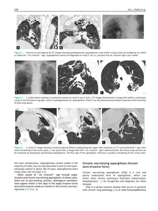 438 M.L. Chabi et al.
Figure 3. Coronal (a) and sagittal (b) CT images showing pathognomonic aspergilloma: mass within a lung cavity surrounded by air, which
is called the ‘‘air crescent’’ sign. Aspergilloma cannot be diagnosed on chest X ray (c), because the air crescent sign is not visible.
Figure 4. a: tuberculosis sequelae in pulmonary apices on chest X ray; b and c: CT images demonstrate a fungus ball within a pulmonary
cavity in the left lower lung apex, which is pathognomonic for aspergilloma. Chest X ray only demonstrates bilateral opacities with retraction
of both lung apices.
Figure 5. a: axial CT image showing a broncho-pleural ﬁstula complicating left upper lobe resection; b: CT scan performed 1 year later
shows thickening of the cavity walls; c: two years later, a fungus ball with ‘‘air crescent’’ sign is demonstrated. All chronic lung cavities can
be colonized by Aspergillus and develop aspergilloma. The ﬁrst sign of the saprophytic infection is usually a thickening of the cavity walls.
the main complication. Aspergillomas remain stable in the
majority of cases, but can also decrease in size or even spon-
taneously resolve in about 10% of cases. Aspergillomas more
rarely show size increase [10].
Other causes of ‘‘air crescent’’ sign include angio-
invasive and chronic necrotizing aspergillosis. In these cases,
there are no pre-existing cavities; radiological manifesta-
tions appear within a few days in the angio-invasive forms
and within several weeks or months in the chronic necrotiz-
ing forms [11] (Fig. 6).
Chronic necrotizing aspergillosis (former
semi-invasive form)
Chronic necrotizing aspergillosis (CNA) is a rare and
poorly understood form of aspergillosis, which can
mimic other chronic pulmonary infections (tuberculosis,
histoplasmosis. . .). Its recognition and diagnosis are often
delayed.
CNA is a locally invasive disease that occurs in patients
with chronic lung pathology [12] or mild immunodeﬁciency
 