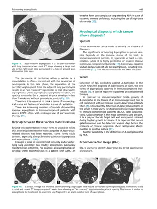 Pulmonary aspergillosis 441
Figure 9. Angio-invasive aspergillosis in a 31-year-old-woman
with lung transplantation. Axial CT image showing a large nod-
ule in the right lower lobe surrounded by a halo of ground glass
attenuation (halo sign).
The occurrence of cavitation within a nodule or a
consolidation is often concomitant with the resolution of
neutropenia. In this late phase, the separation of the
necrotic lung fragment from the adjacent lung parenchyma
results in an ‘‘air crescent’’ sign similar to that observed in
aspergilloma. Unlike saprophytic aspergillosis infection, the
opacity surrounded by a crescent airspace develops in less
than 2 weeks and without pre-existing cavity (Fig. 10).
Therefore, it is essential to think in terms of immunolog-
ical status and fastness of evolution in case of cavitation.
There are increasing numbers of reports documenting
invasive aspergillosis in immunocompetent patients with
severe COPD, often with prolonged use of corticosteroid
therapy [11].
Overlap between these various manifestations
Beyond this segmentation in four forms it should be noted
that an overlap between the main categories of Aspergillus-
related diseases has been reported. Some forms could
co-exist, especially allergic broncho-pulmonary aspergillosis
and aspergilloma [11,20].
Changes of local or systemic host immunity and of under-
lying lung pathology can modify aspergillosis pulmonary
manifestations with time. For example, an aspergilloma can
develop within bronchiectasis in a patient with ABPA. An
invasive form can complicate long-standing ABPA in case of
systemic immune deﬁciency, including the use of high-dose
of steroids [20].
Mycological diagnosis: which sample
allows diagnosis?
Sputum
Direct examination can be made to identify the presence of
ﬁlaments.
The signiﬁcance of isolating Aspergillus in sputum sam-
ples depends on the immune status of the host. In
immunocompetent patients, it represents at least a colo-
nization, while it is highly predictive of invasive disease
in immuno-compromised patients [11]. Conversely, negative
sputum samples do not rule out aspergillosis, including inva-
sive forms [11]. The results of cultures are often delayed.
Serum
Detection of IgG antibodies against A. fumigatus in the
serum helps the diagnosis of aspergilloma or ABPA, the two
forms of aspergillosis observed in immunocompetent indi-
viduals [1]. It can be negative in patients on corticosteroid
therapy.
In contrast to immunocompetent hosts, growth of
A. fumigatus in the tissues of an immunosuppressed host is
not correlated with an increase in anti-Aspergillus antibody
titers [1]. Consequently, detection of Aspergillus antigens in
the serum is more useful for diagnosing invasive aspergillosis
in immuno-compromised patients (ELISA, latex agglutina-
tion). Galactomannan is the most commonly used antigen,
it is a polysaccharide fungal cell wall component released
during hyphal growth in tissues. It is reported that serum
galactomannan can be detected several days before the
presence of clinical symptoms, chest radiographic abnor-
malities or positive culture [11].
Another possibility is the detection of A. fumigatus DNA
by PCR.
Bronchoalveolar lavage (BAL)
BAL is useful to identify Aspergillus by direct examination
and culture.
Figure 10. a: axial CT image in a leukemia patient showing a right upper lobe nodule surrounded by mild ground glass attenuation; b and
c: axial and coronal CT images acquired 3 weeks later showing an ‘‘air crescent’’ sign surrounding a focal opacity. This feature is similar to
aspergilloma but is relevant to a necrotic lung fragment in an angio-invasive form of aspergillosis.
 