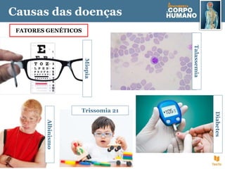 Causas das doenças
FATORES GENÉTICOS
Miopia
Talassemia
Diabetes
Trissomia 21
Albinismo
 