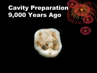 Cavity Preparation
9,000 Years Ago
 