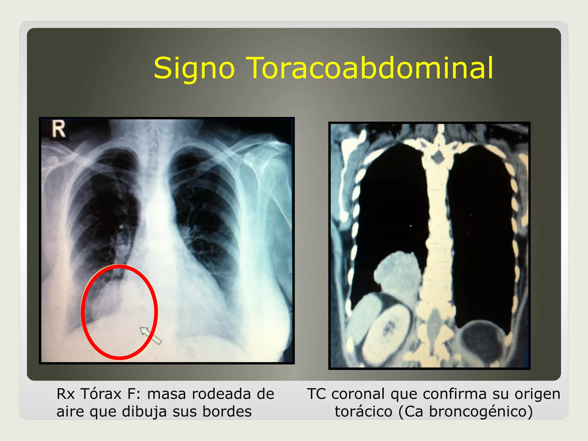 signos-radiologicos-de-torax-ppt