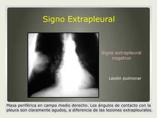 Signos radiologicos de Torax | PPT