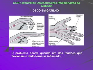 DORT-Distúrbios Osteomuslares Relacionados ao
Trabalho
DEDO EM GATILHO
O problema ocorre quando um dos tendões que
flexion...