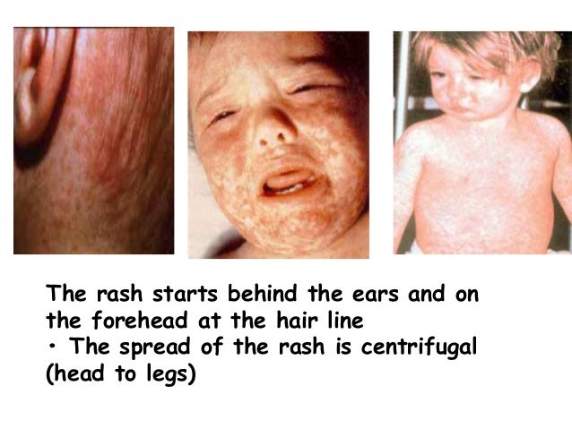 Pneumonia Skin Rash