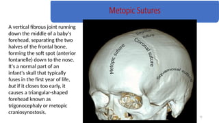 Metopic Ridge Soft 1-SKULL Lecture presentation with bones & attachments | PPTX