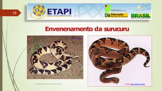 19
Envenenamento da surucuru
Fonte: www.hospvirt.org.br.
www.fiocruz.br
Engenheiro Zacarias Linhares Junior
 