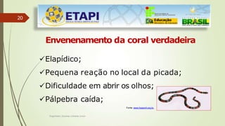 20
Envenenamento da coral verdadeira
Elapídico;
Pequena reação no local da picada;
Dificuldade em abrir os olhos;
Pálpebra caída;
Fonte: www.hospvirt.org.br.
Engenheiro Zacarias Linhares Junior
 