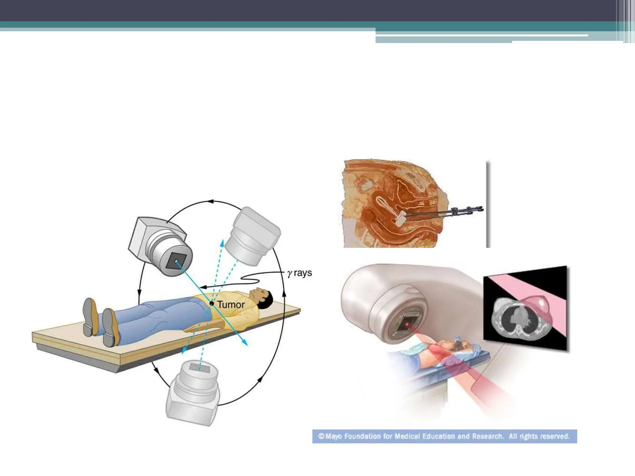 Radiotherapy ppt. Types of radiation and chronic | PPTX