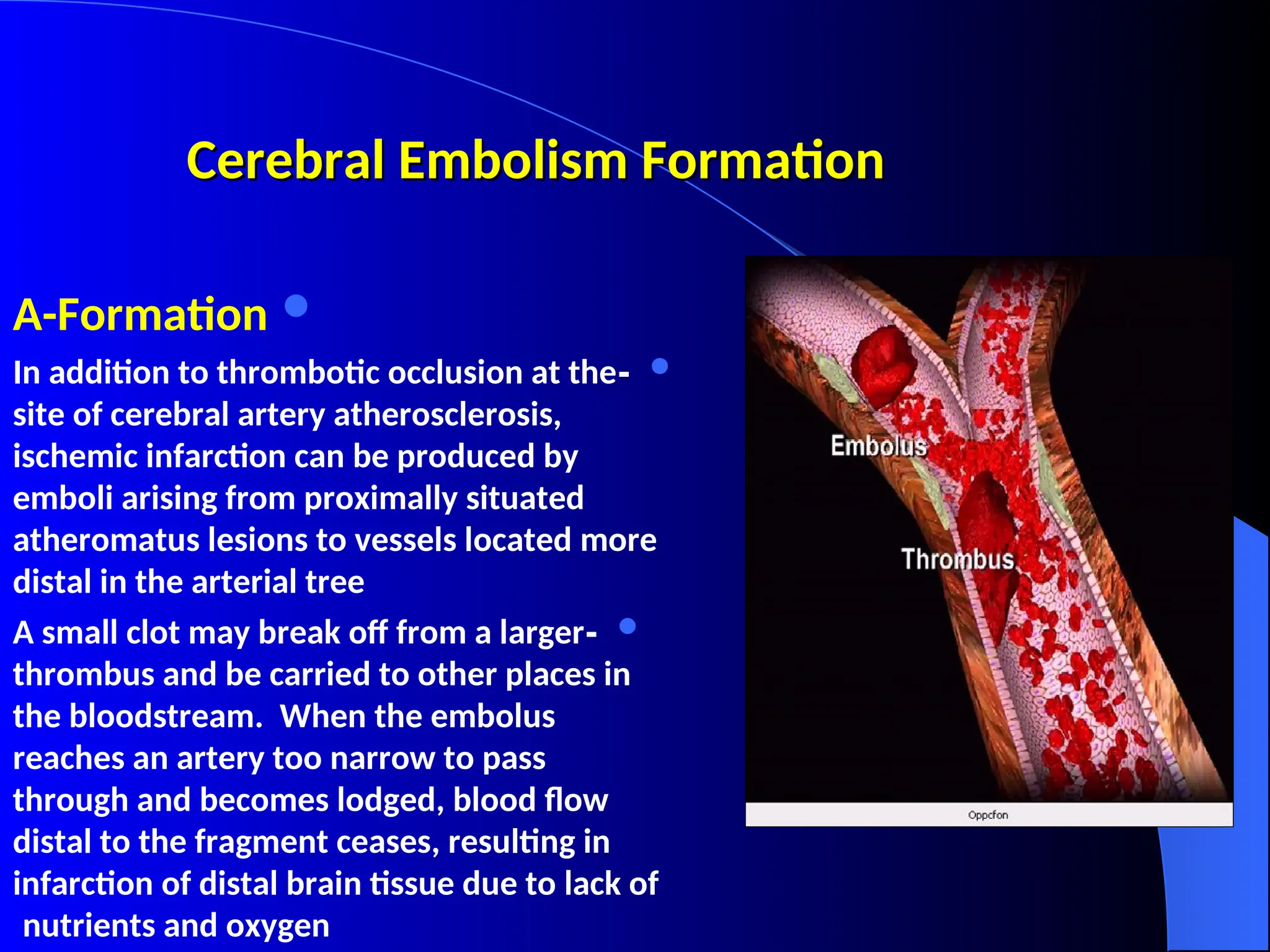 Cerebral Embolism Formation
Cerebral Embolism Formation

A-Formation

-
In addition to thrombotic occlusion at the
site of cerebral artery atherosclerosis,
ischemic infarction can be produced by
emboli arising from proximally situated
atheromatus lesions to vessels located more
distal in the arterial tree

-
A small clot may break off from a larger
thrombus and be carried to other places in
the bloodstream. When the embolus
reaches an artery too narrow to pass
through and becomes lodged, blood flow
distal to the fragment ceases, resulting in
infarction of distal brain tissue due to lack of
nutrients and oxygen
 
