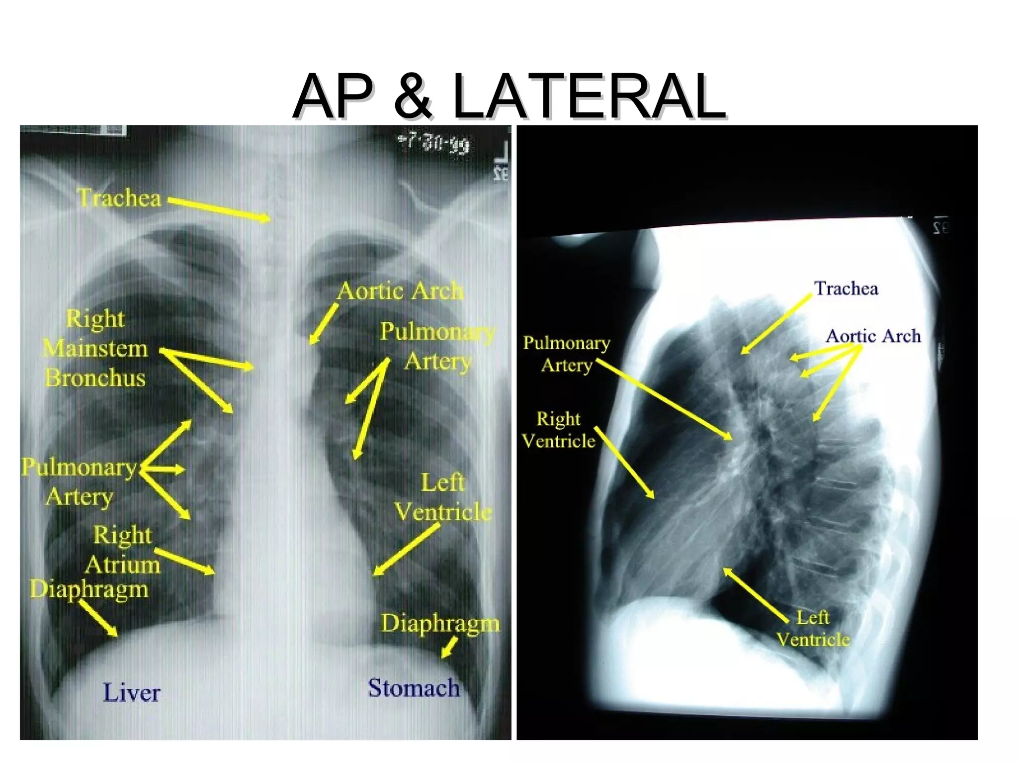 AP & LATERAL
 