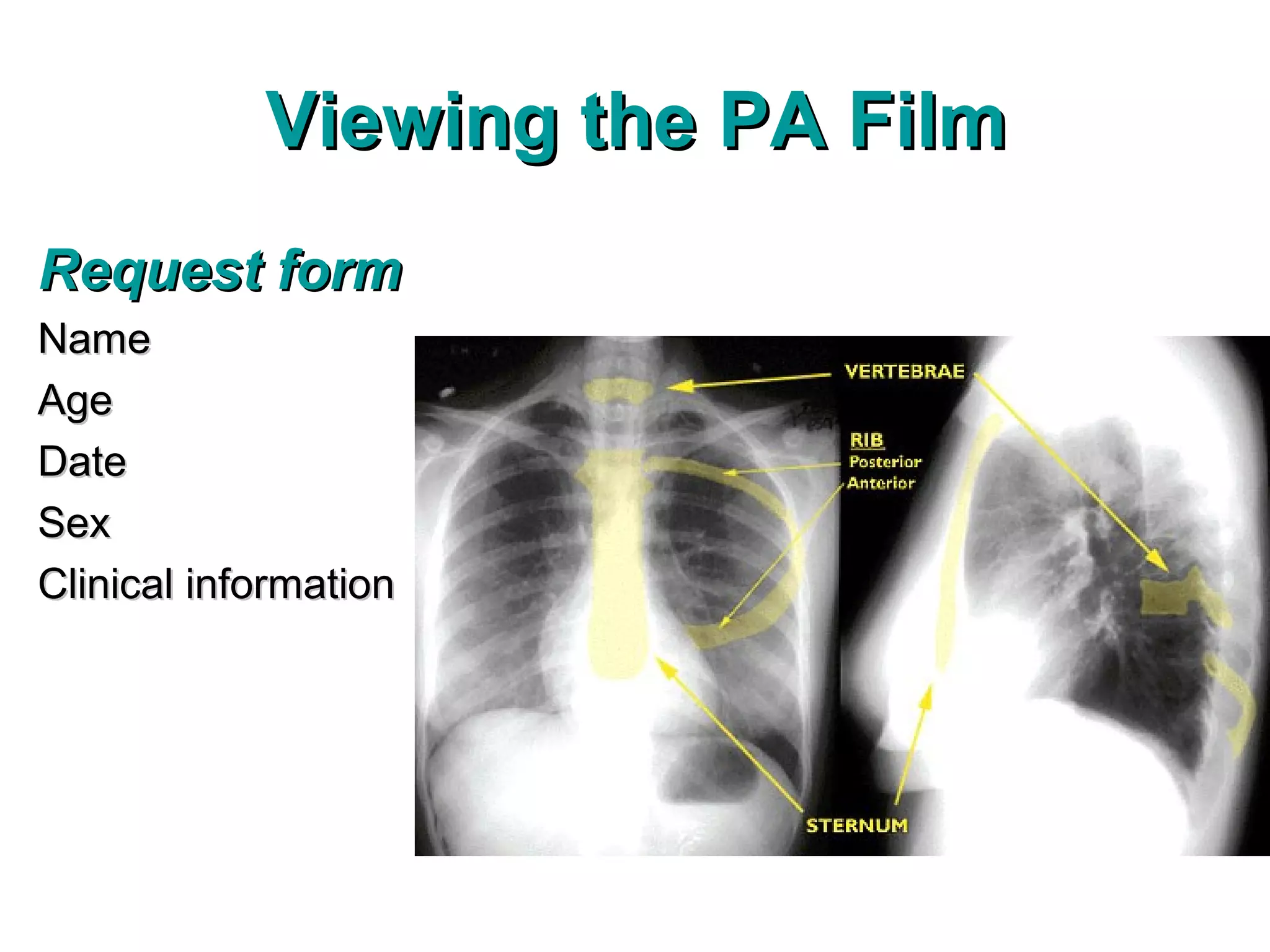Viewing the PA Film
Request form
Name
Age
Date
Sex
Clinical information
 