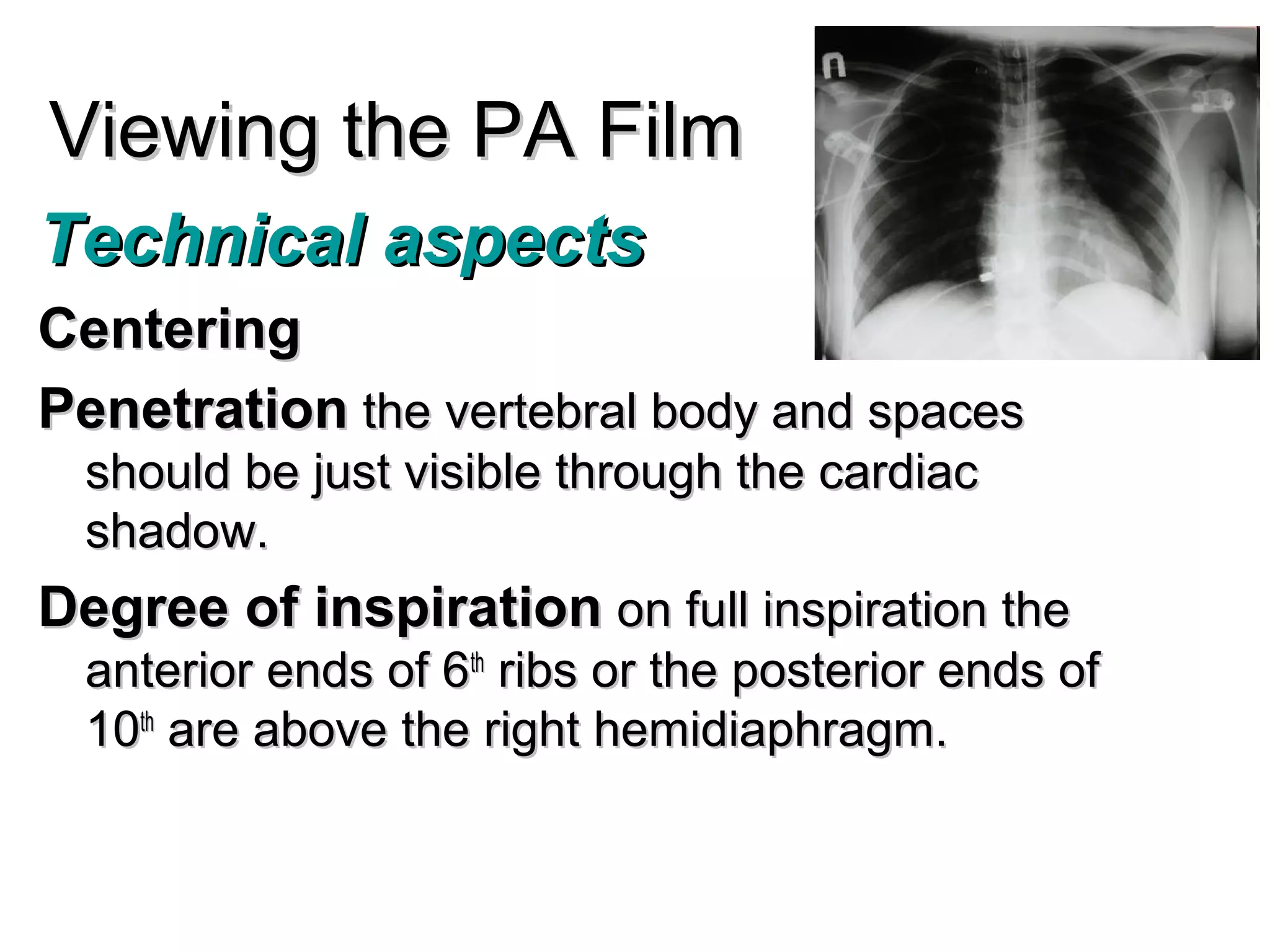Viewing the PA Film
Technical aspects
Centering
Penetration the vertebral body and spaces
  should be just visible through the cardiac
  shadow.
Degree of inspiration on full inspiration the
  anterior ends of 6th ribs or the posterior ends of
  10th are above the right hemidiaphragm.
 