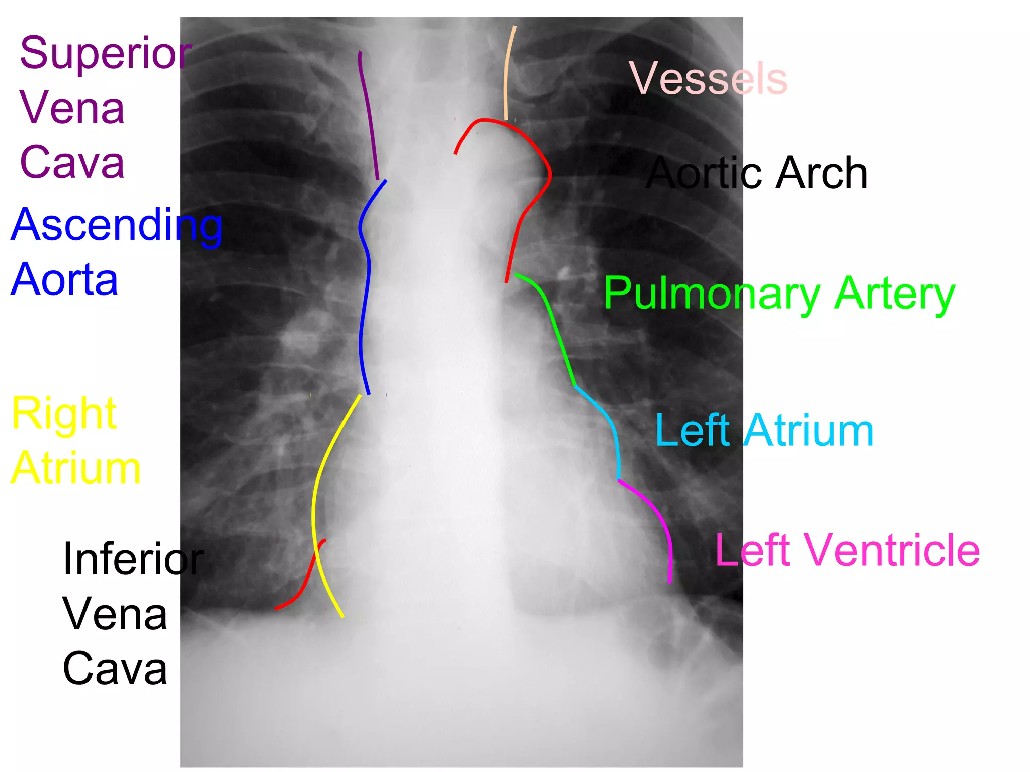 Superior
              Vessels
Vena
Cava          Aortic Arch
Ascending
Aorta        Pulmonary Artery

Right          Left Atrium
Atrium
  Inferior        Left Ventricle
  Vena
  Cava
 
