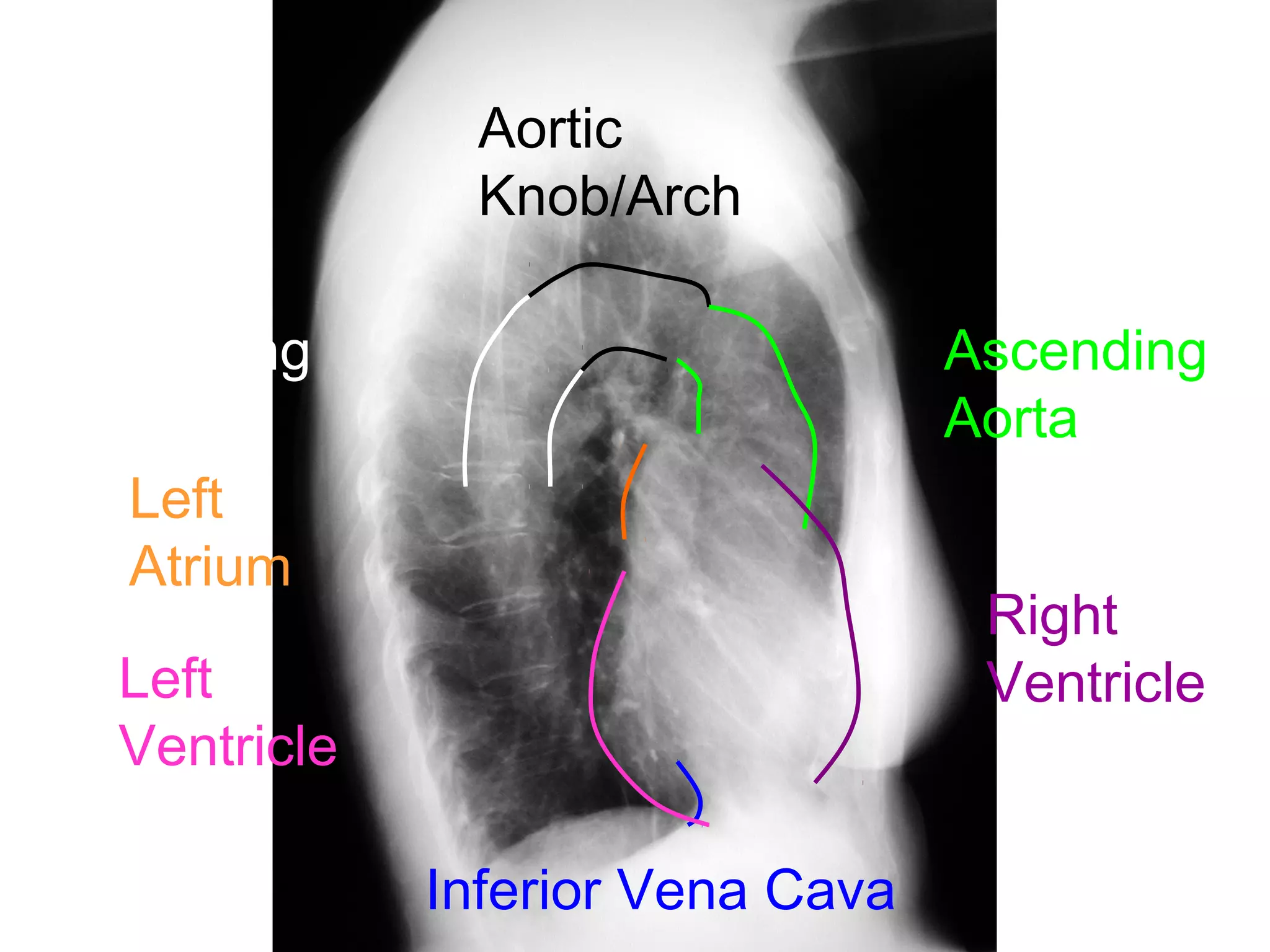 Aortic
                 Knob/Arch

Descending                          Ascending
Aorta                               Aorta
    Left
    Atrium
                                     Right
   Left                              Ventricle
   Ventricle

               Inferior Vena Cava
 