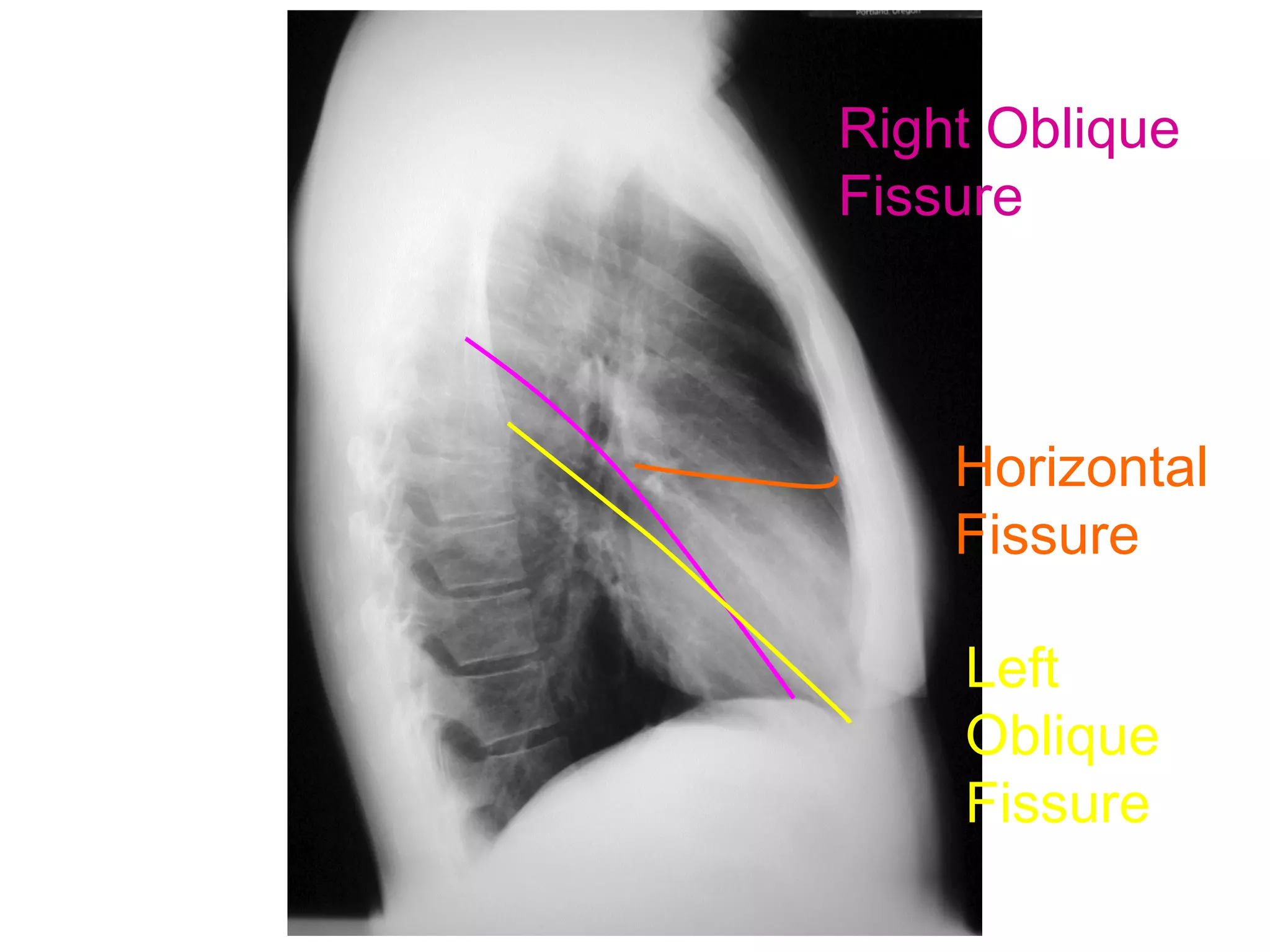 Right Oblique
Fissure



    Horizontal
    Fissure

    Left
    Oblique
    Fissure
 