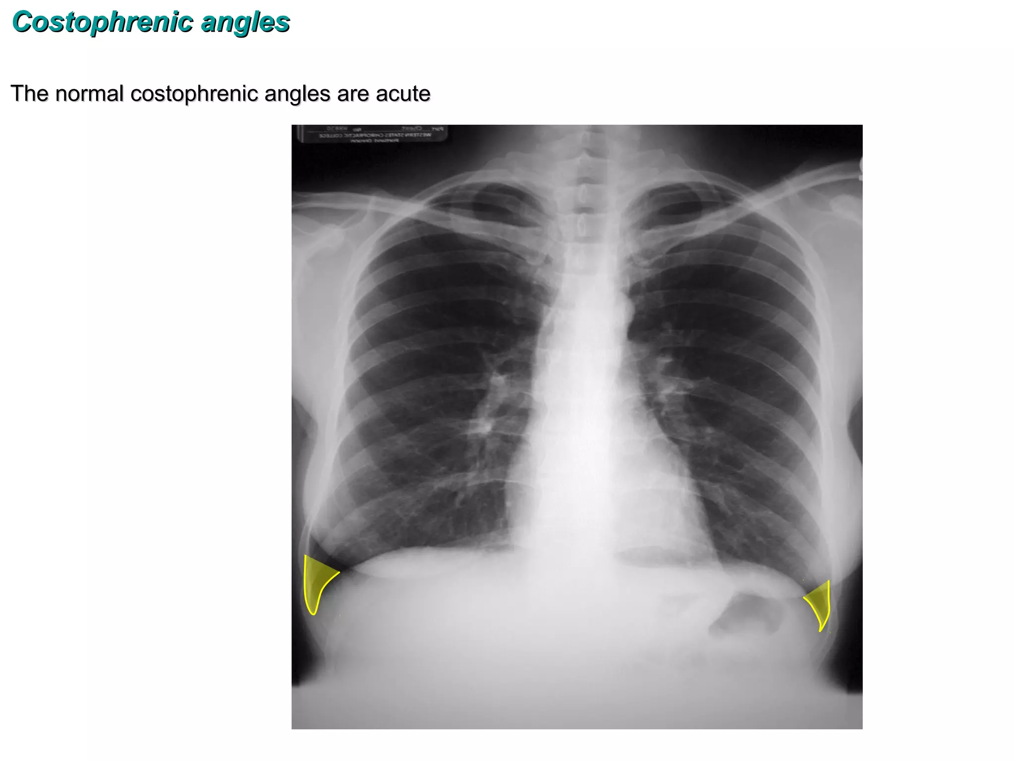 Costophrenic angles

The normal costophrenic angles are acute
 