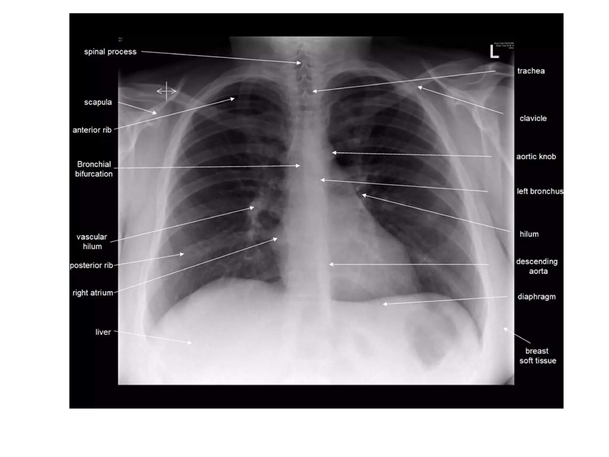 1 The Normal Cxr PPT 1 The Normal Cxr PPT