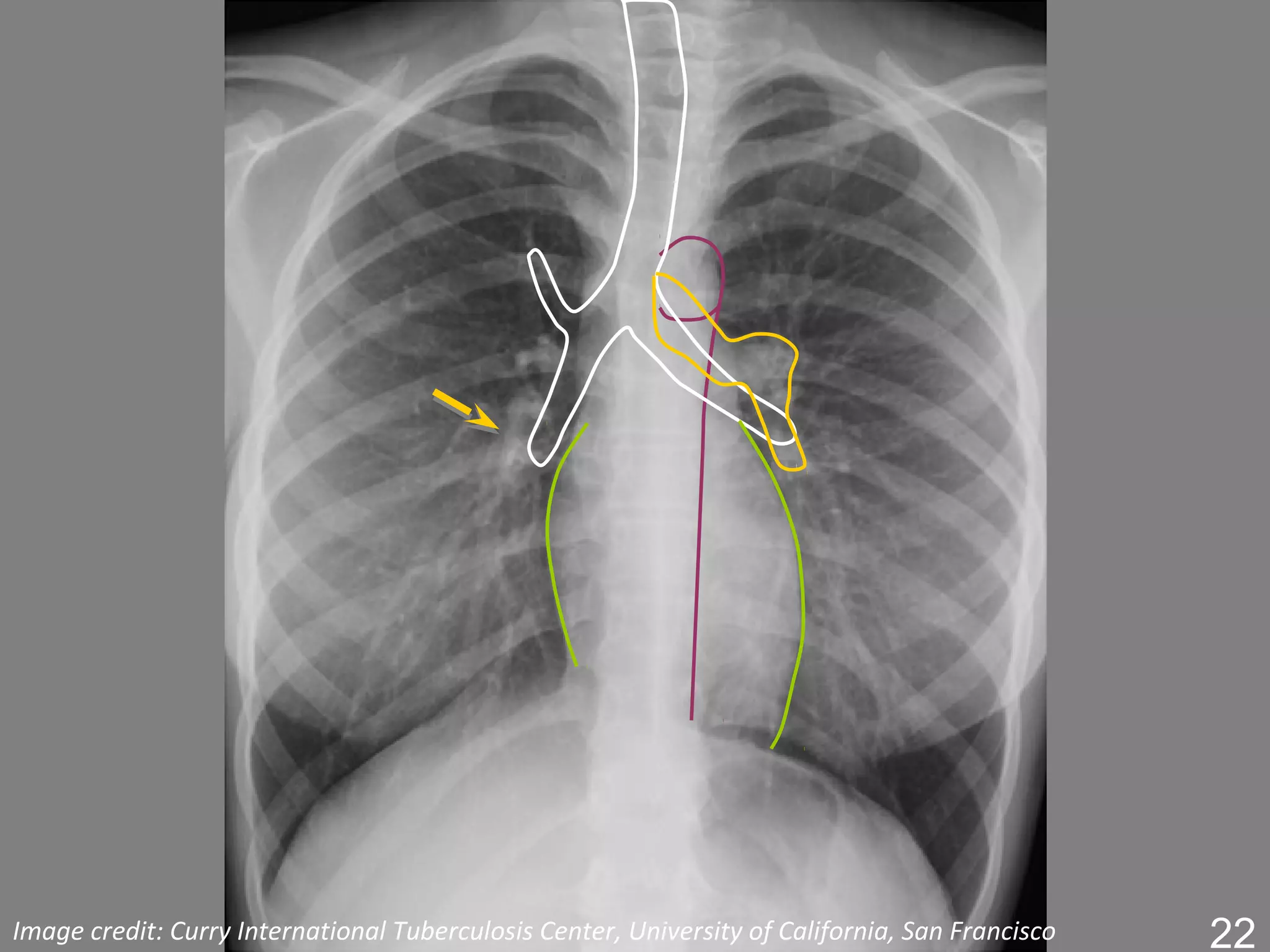 Image credit: Curry International Tuberculosis Center, University of California, San Francisco   22
 