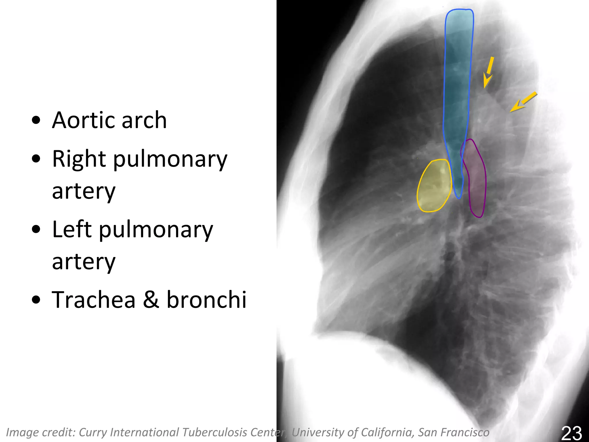 • Aortic arch
    • Right pulmonary
      artery
    • Left pulmonary
      artery
    • Trachea & bronchi



Image credit: Curry International Tuberculosis Center, University of California, San Francisco   23
 
