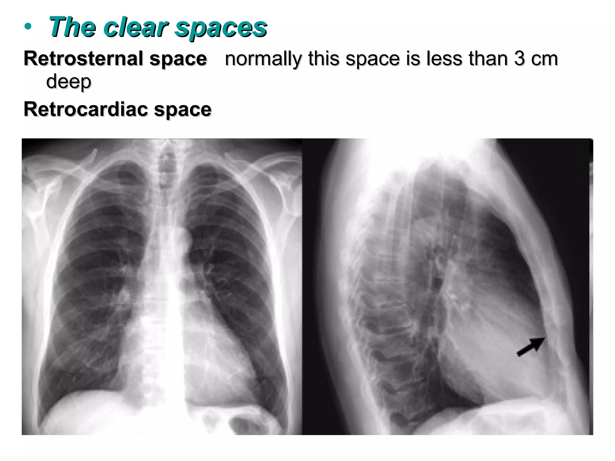 • The clear spaces
Retrosternal space normally this space is less than 3 cm
  deep
Retrocardiac space
 