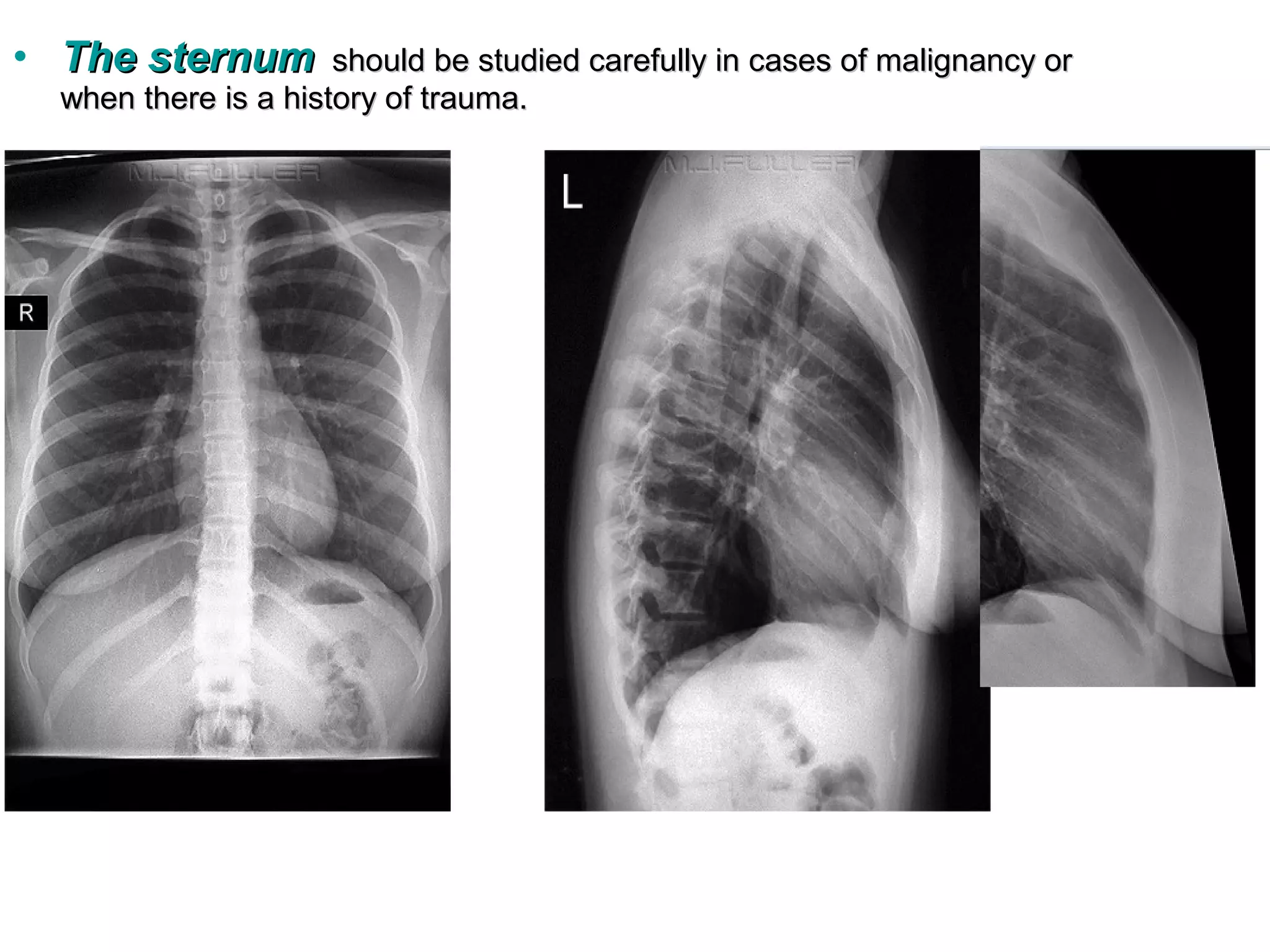• The sternum         should be studied carefully in cases of malignancy or
  when there is a history of trauma.
 