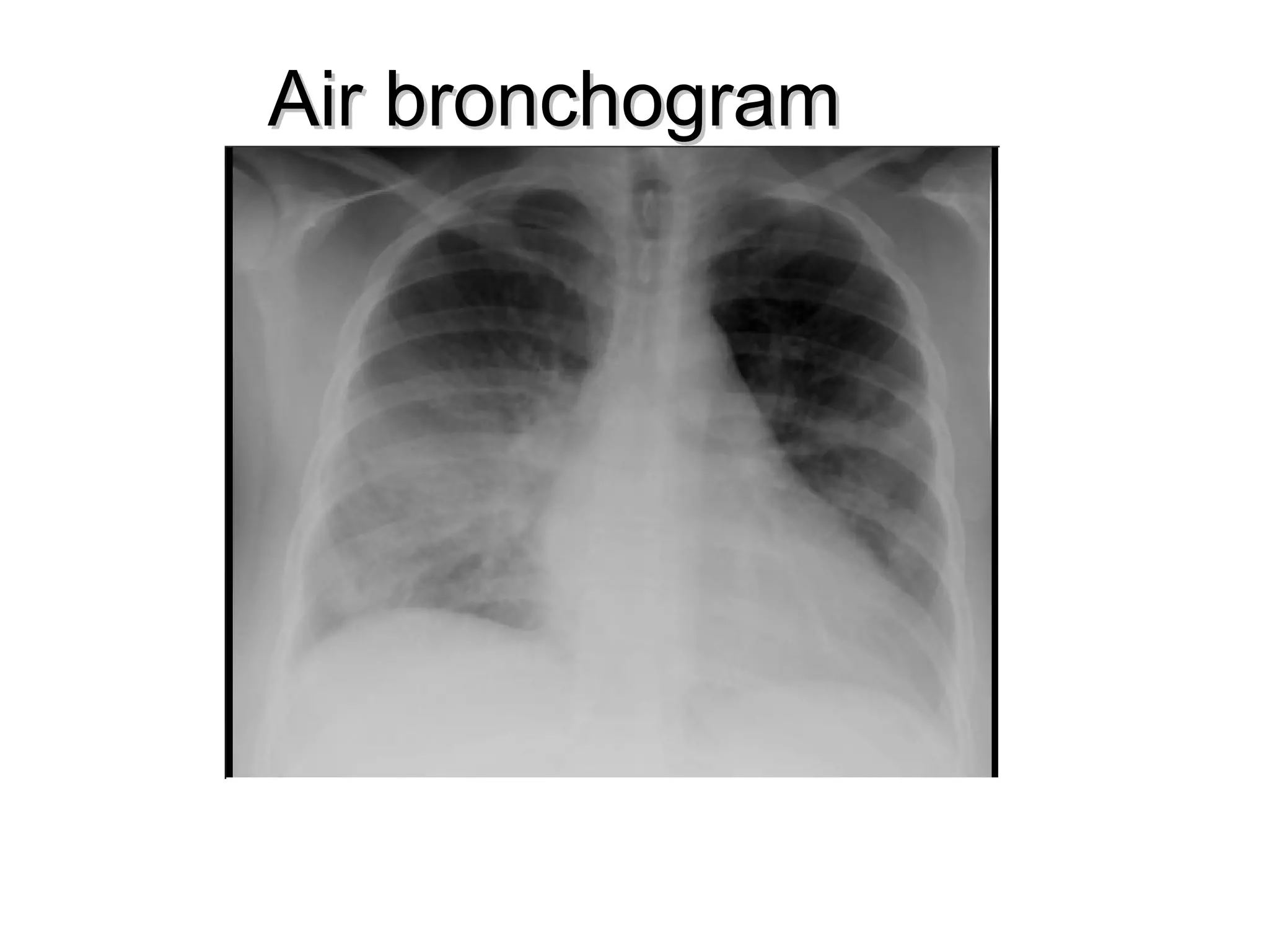 Air bronchogram
 