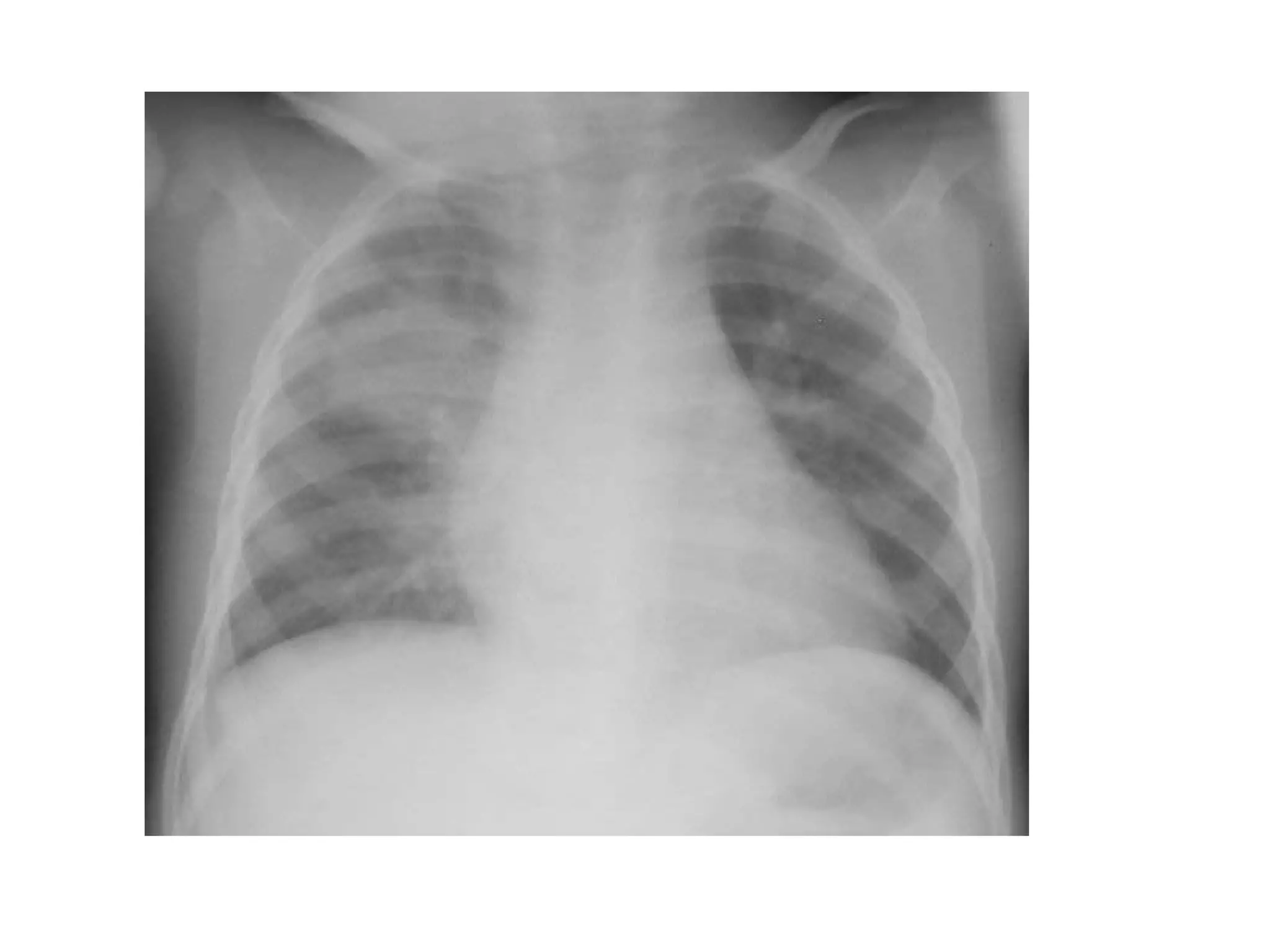 1 the normal cxr