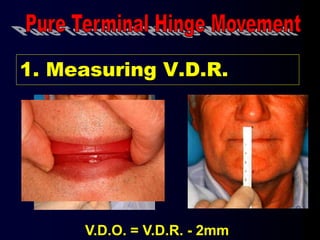 1. Measuring V.D.R.
V.D.O. = V.D.R. - 2mm
 