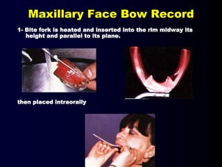 Maxillary Face Bow Record
1- Bite fork is heated and inserted into the rim midway its
height and parallel to its plane.
then placed intraorally
 
