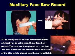 2-The condylar axis is then determined either
arbitrarily or by using mandibular face bow
record. The rods are then placed on it ,so that
the bow surrounds the patient’s face. The stem
of the bite fork is slipped into the universal joint.
11- 13 mm
Maxillary Face Bow Record
 