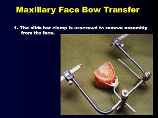 1- The slide bar clamp is unscrewd to remove assembly
from the face.
Maxillary Face Bow Transfer
 