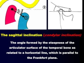The angle formed by the steepness of the
articulator surface of the temporal bone as
related to a horizontal line, which is parallel to
the Frankfort plane.
The sagittal inclination (condylar inclination)
 