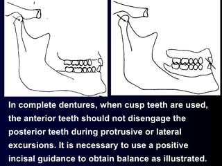 In complete dentures, when cusp teeth are used,
the anterior teeth should not disengage the
posterior teeth during protrusive or lateral
excursions. It is necessary to use a positive
incisal guidance to obtain balance as illustrated.
 