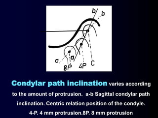 Condylar path inclination varies according
to the amount of protrusion. a-b Sagittal condylar path
inclination. Centric relation position of the condyle.
4-P. 4 mm protrusion.8P. 8 mm protrusion
 