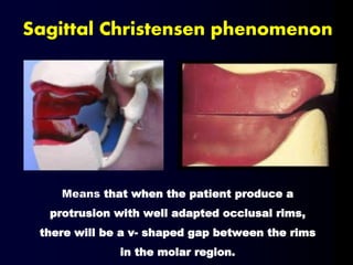 Means that when the patient produce a
protrusion with well adapted occlusal rims,
there will be a v- shaped gap between the rims
in the molar region.
Sagittal Christensen phenomenon
 
