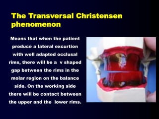 Means that when the patient
produce a lateral excurtion
with well adapted occlusal
rims, there will be a v shaped
gap between the rims in the
molar region on the balance
side. On the working side
there will be contact between
the upper and the lower rims.
The Transversal Christensen
phenomenon
 