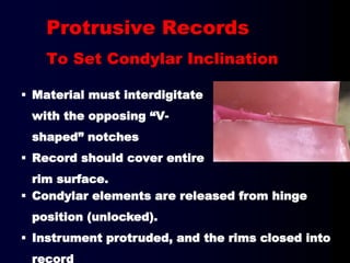 Protrusive Records
To Set Condylar Inclination
 Material must interdigitate
with the opposing “V-
shaped” notches
 Record should cover entire
rim surface.
 Condylar elements are released from hinge
position (unlocked).
 Instrument protruded, and the rims closed into
record
 