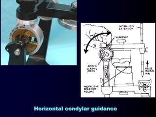 Horizontal condylar guidance
 