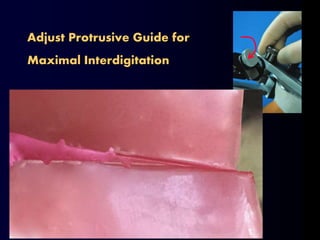 Adjust Protrusive Guide for
Maximal Interdigitation
 