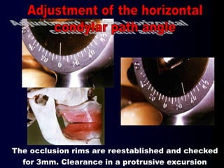 The occlusion rims are reestablished and checked
for 3mm. Clearance in a protrusive excursion
 