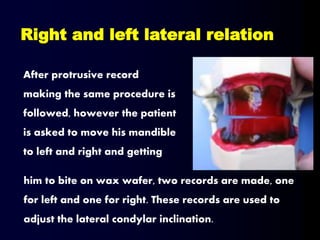 After protrusive record
making the same procedure is
followed, however the patient
is asked to move his mandible
to left and right and getting
Right and left lateral relation
him to bite on wax wafer, two records are made, one
for left and one for right. These records are used to
adjust the lateral condylar inclination.
 