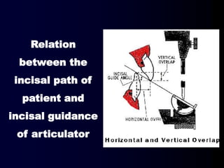 Relation
between the
incisal path of
patient and
incisal guidance
of articulator
 