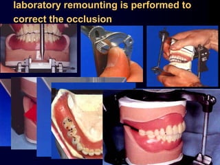 laboratory remounting is performed to
correct the occlusion
 