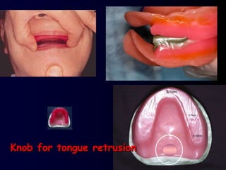 Knob for tongue retrusion
 
